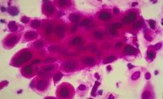 انتبه.. هذه الأعراض الستة قد تشير إلى إصابتك بالسرطان