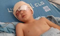 استئصال عين طفل أصيب برصاص الاحتلال في العيسوية