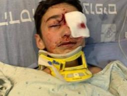 طفل مقدسي مهدد بفقدان عينه إثر إصابته برصاص الاحتلال