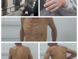 نادي الأسير الفلسطيني: الأسرى المحررون يعانون من مشاكل صحية خطيرة