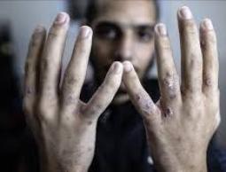 الزغاري: سجون الاحتلال (الإسرائيلي) تحوّلت إلى ساحات قتل بطيء وتعذيب ممنهج