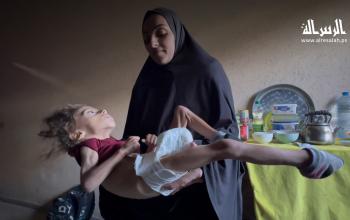الطفلة مسك المدهون تعاني من ضمور في الجسد وشلل دماغي وسوء تغذية، وسط ظروف مأساوية صعبة