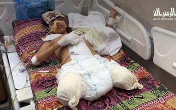 صبا أبو عابدة: طفولة مبتورة الأقدام بفعل نيران قصف الاحتلال الصهيوني