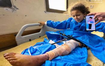 الطفلة سيلا ماضي (8 سنوات) فقدت ساقها اليمنى وتعاني من خطر بتر اليسرى بسبب القصف الإسرائيلي على قطاع غزة