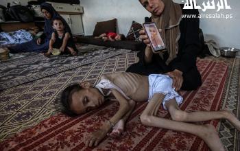 الطفلة مريم عبد العزيز محمود دواس (9 أعوام) تتلقى الرعاية من أسرتها داخل خيمة بمدينة غزة، حيث تعاني من سوء تغذية حاد أفقدها القدرة على المشي، وانخفض وزنها من 25 إلى 10 كيلوغرامات