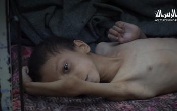 الطفل نافذ نصر يعاني اضطرابات نفسية وسوء تغذية بلا دواء