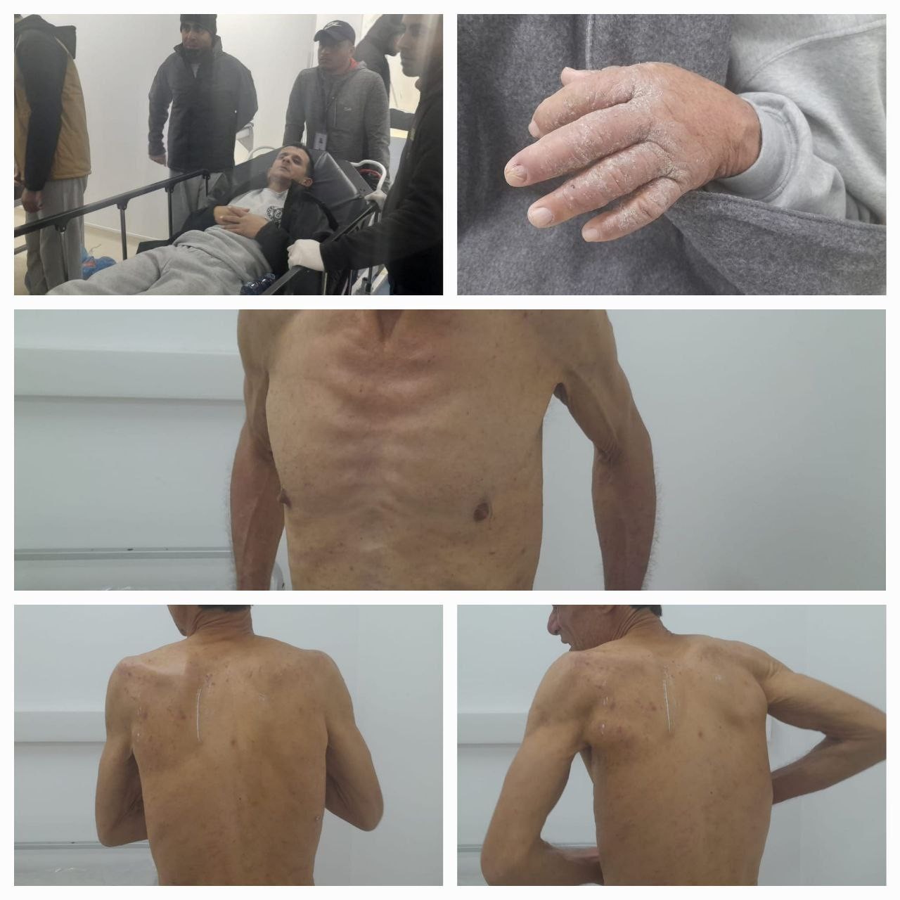 نادي الأسير الفلسطيني: الأسرى المحررون يعانون من مشاكل صحية خطيرة