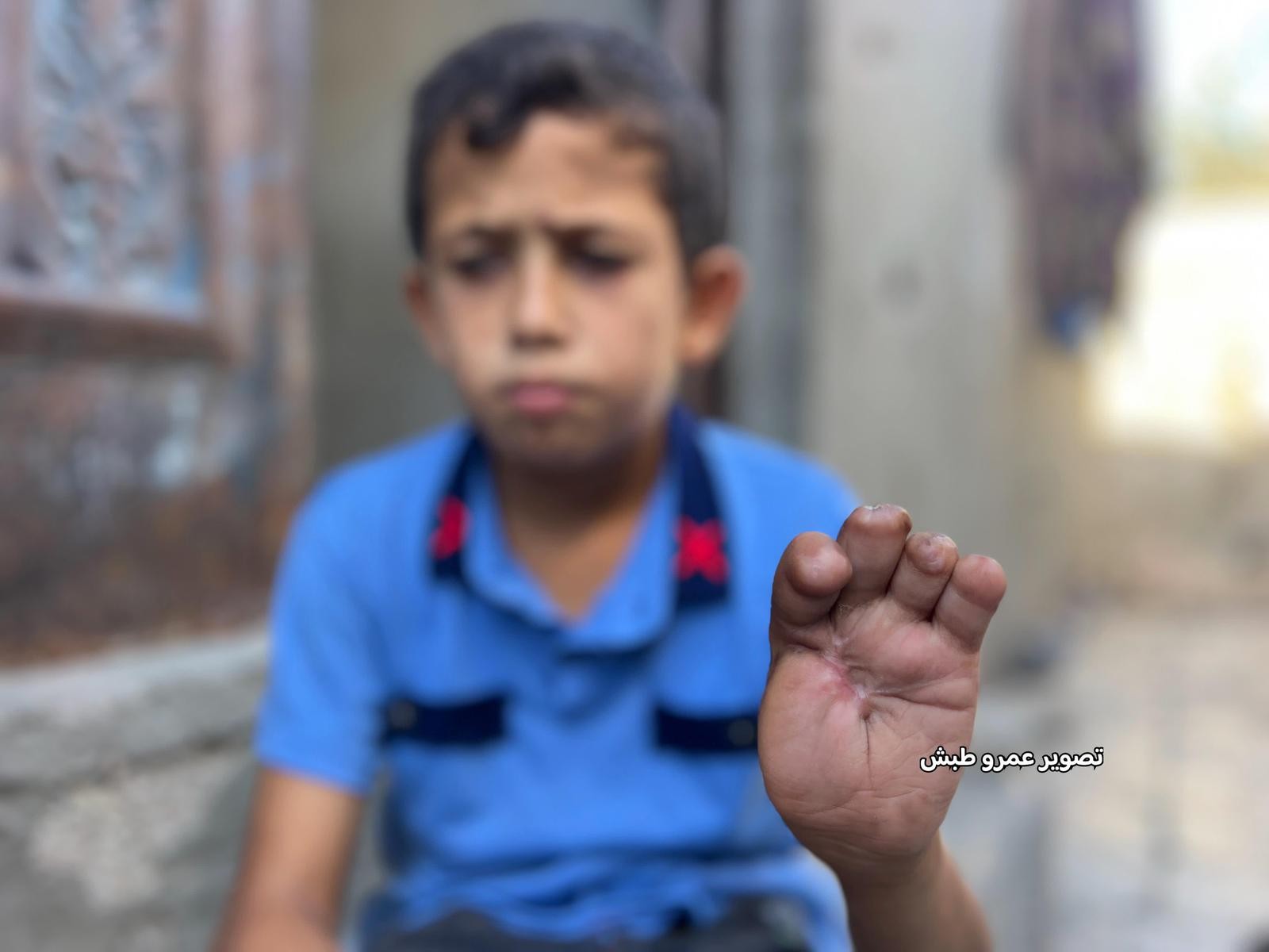 راكان… حين فقد أصابعه بعلبة سمك مفخخة