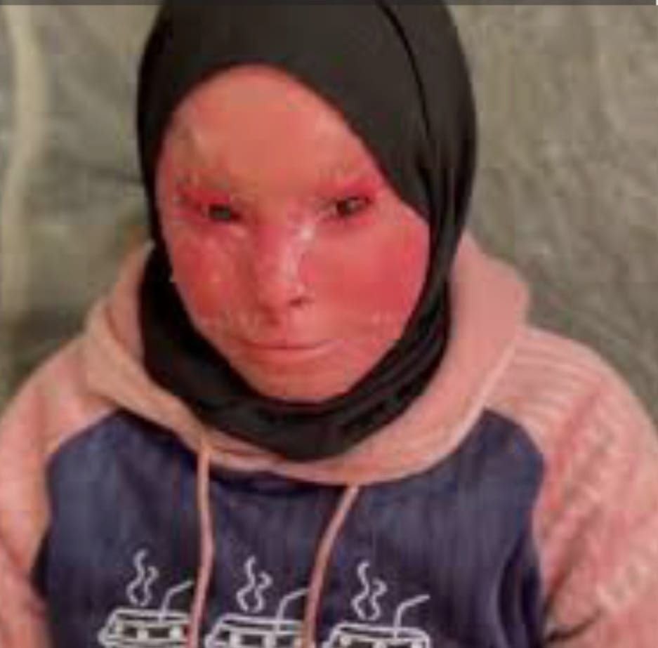 شهد العفيفي… طفولة شوهها المرض وقسوة الحصار