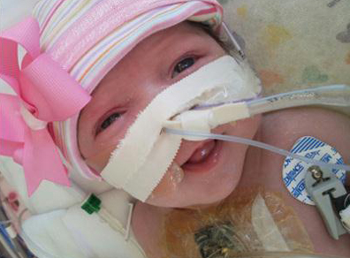 صورة للرضيعة بعد اجراء العملية