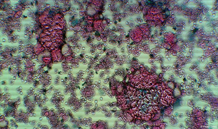 خلايا سرطانية 
