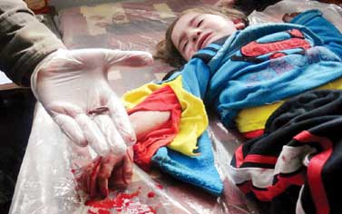 طبيب يعرض رصاصة اخرجها من جسد طفلة